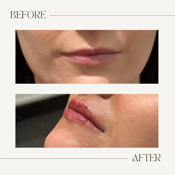 dermal fillers Cheshire - Lip fillers