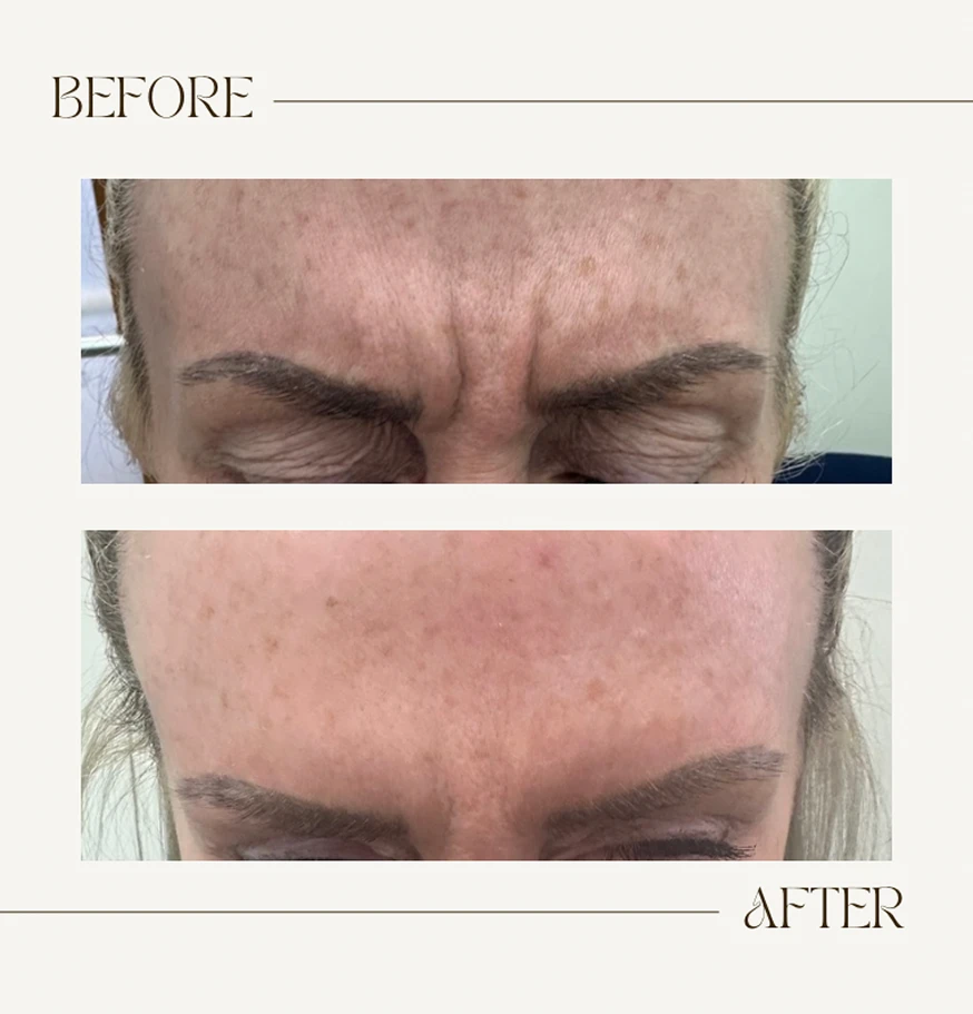 Anti Wrinkle Injections Wilmslow - Before and after results - The Aesthetics Suite - The Aesthetics Suite anti wrinkle injections Wilmslow