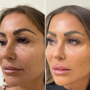 Under eye polynucleotides Aesthetic Clinic Wilmslow