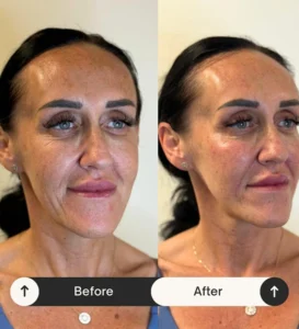 skin boosters cheshire - Profhilo before and after