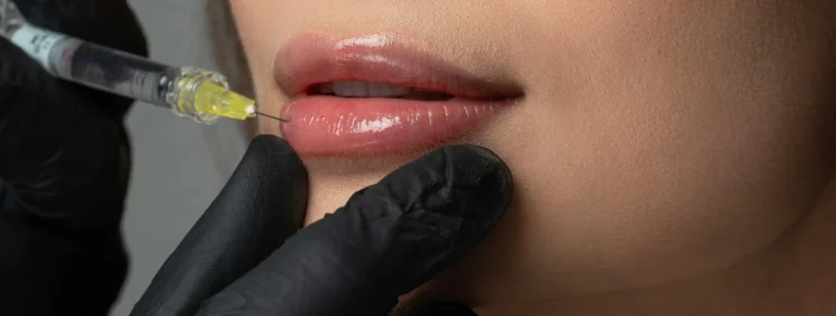 Lip fillers in Wilmslow Cheshire