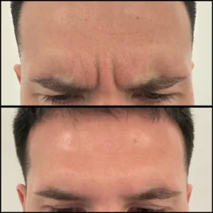 anti-wrinkle injection resulta at 2 weeks review