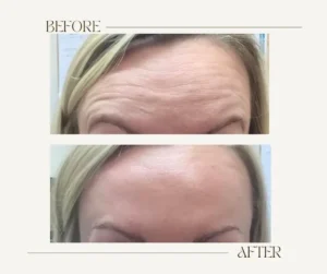 How Long Do Anti-Wrinkle Injections Last? Before and after results