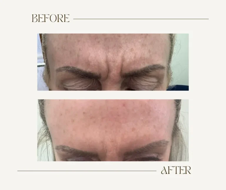 anti-wrinkle injections for frown lines in Cheshire